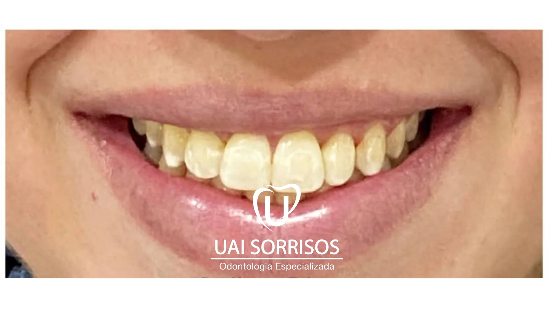 Antes