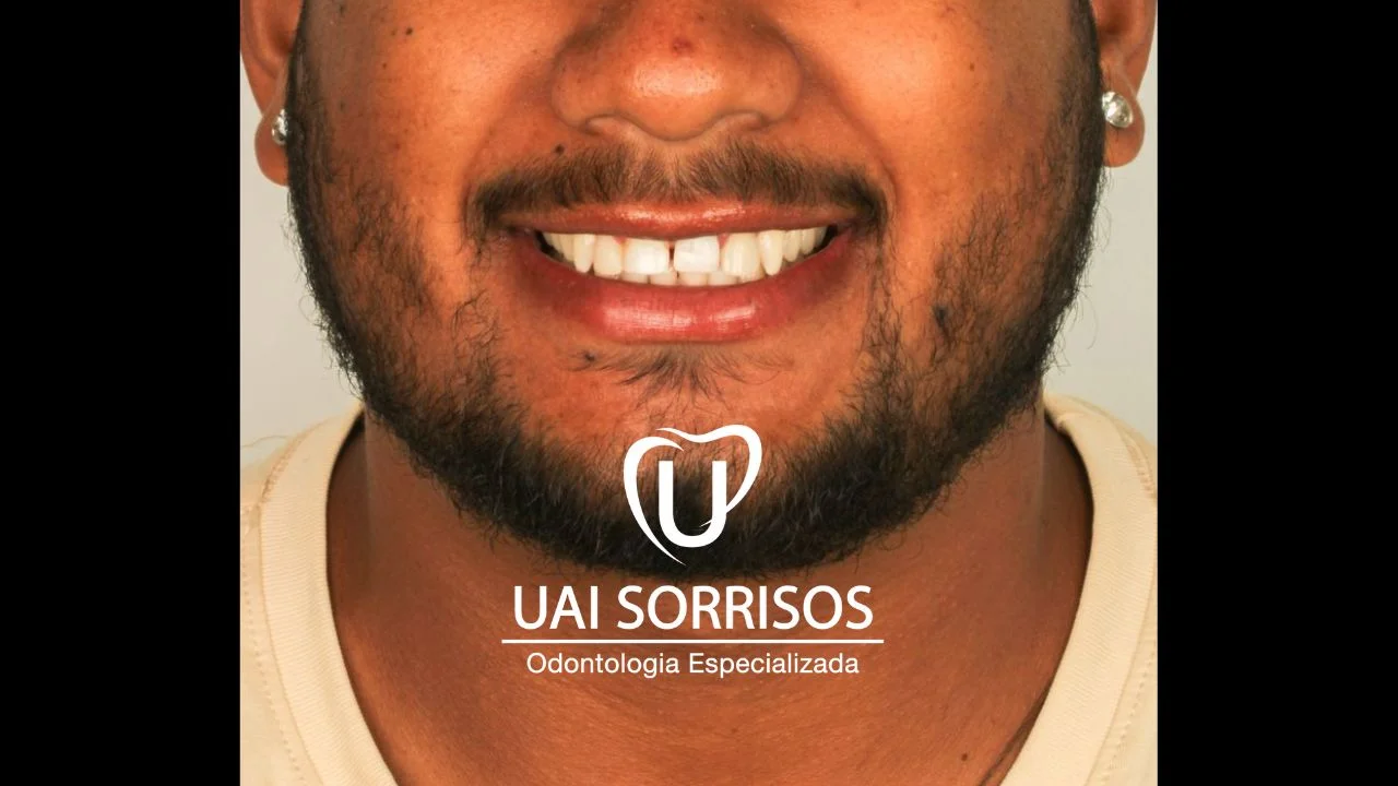 Antes