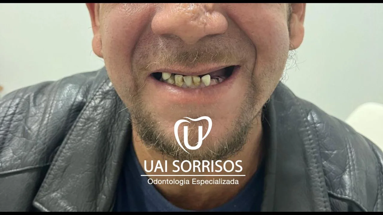 Antes