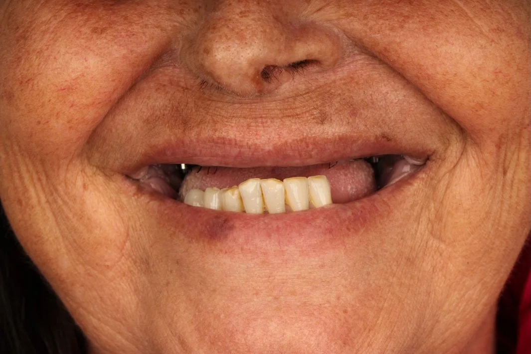Antes
